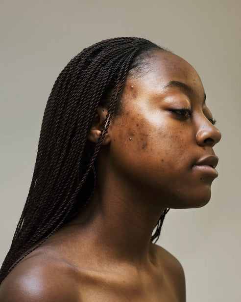 Ketika Basic Skincare Tak Lagi Dapat Mengatasi Jerawat